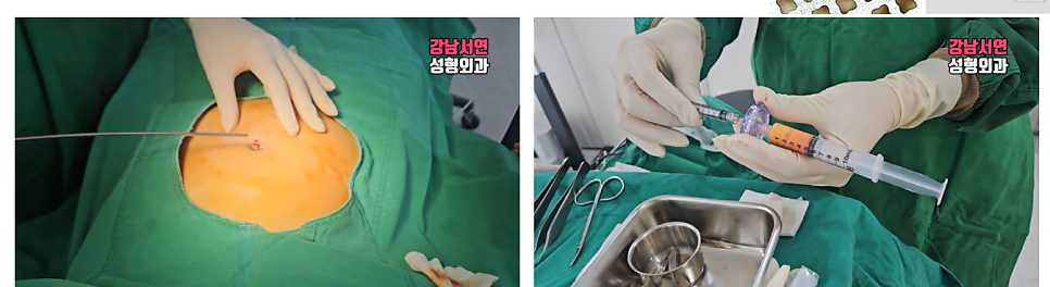 두줄따기 수술 장면