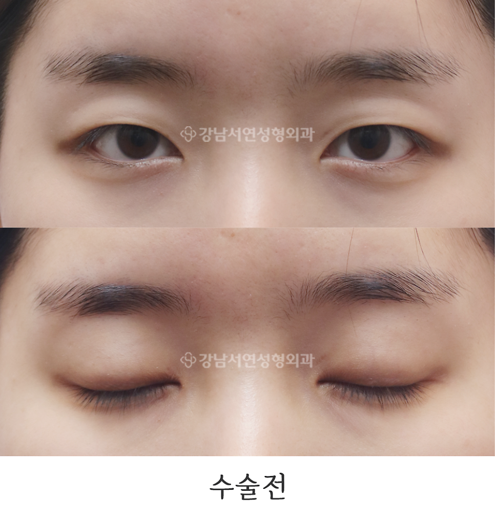 눈매교정 수술 전 사진