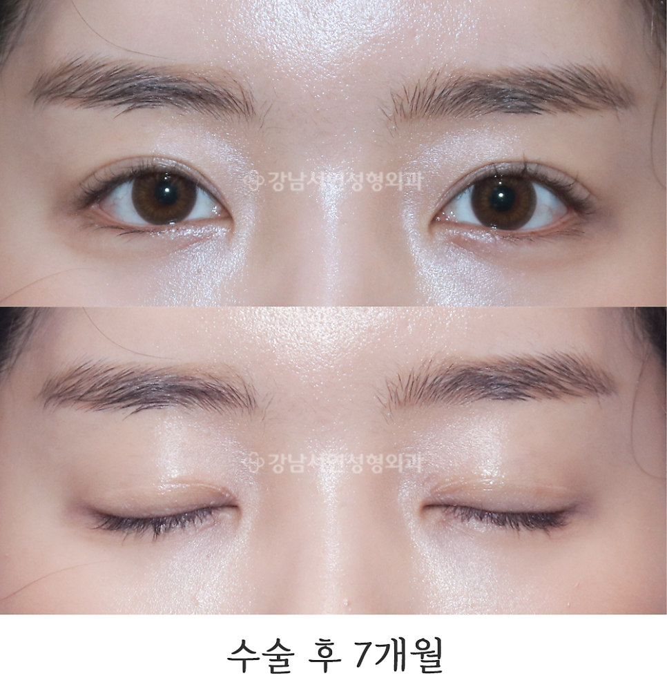 눈매교정 수술 후 사진