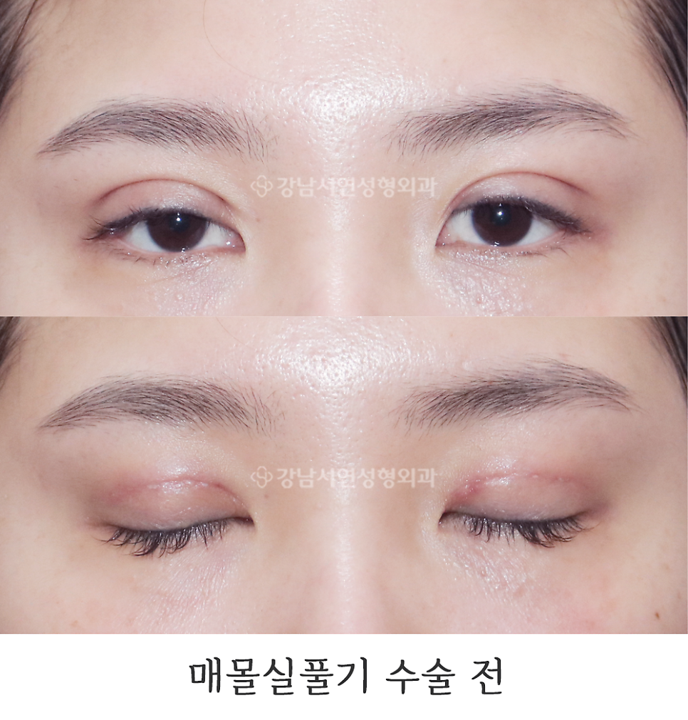 쌍꺼풀 재수술 전 사진