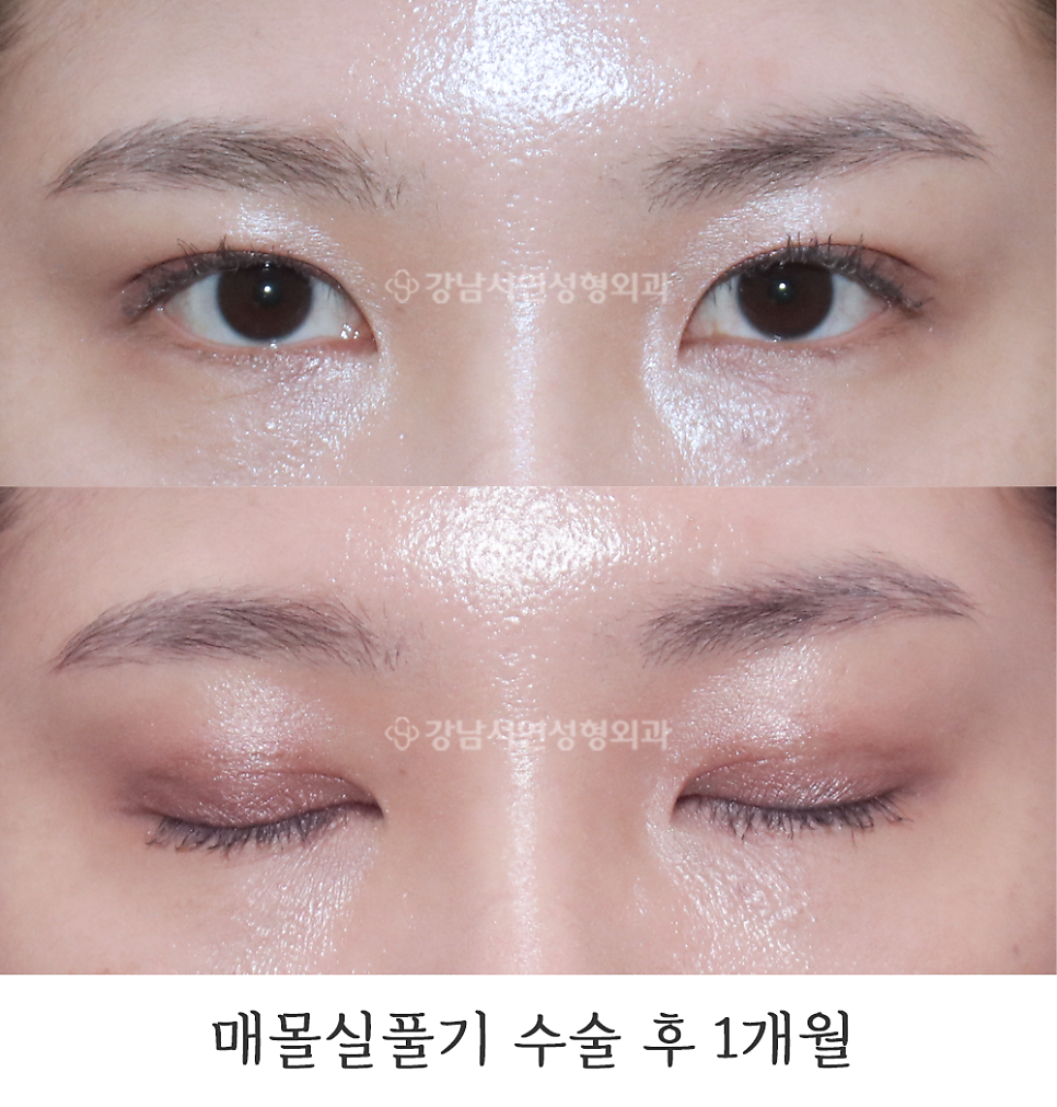 쌍꺼풀 재수술 후 사진