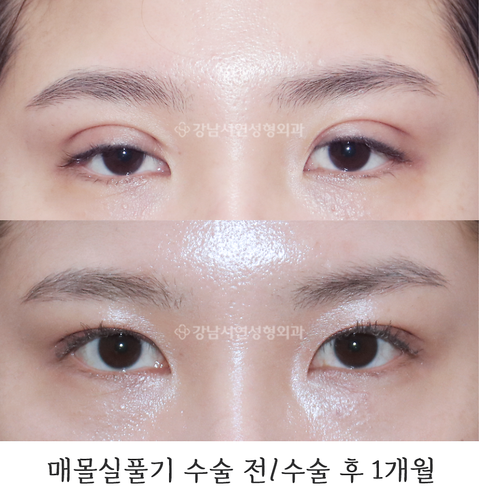 쌍꺼풀 재수술 전후 비교 사진