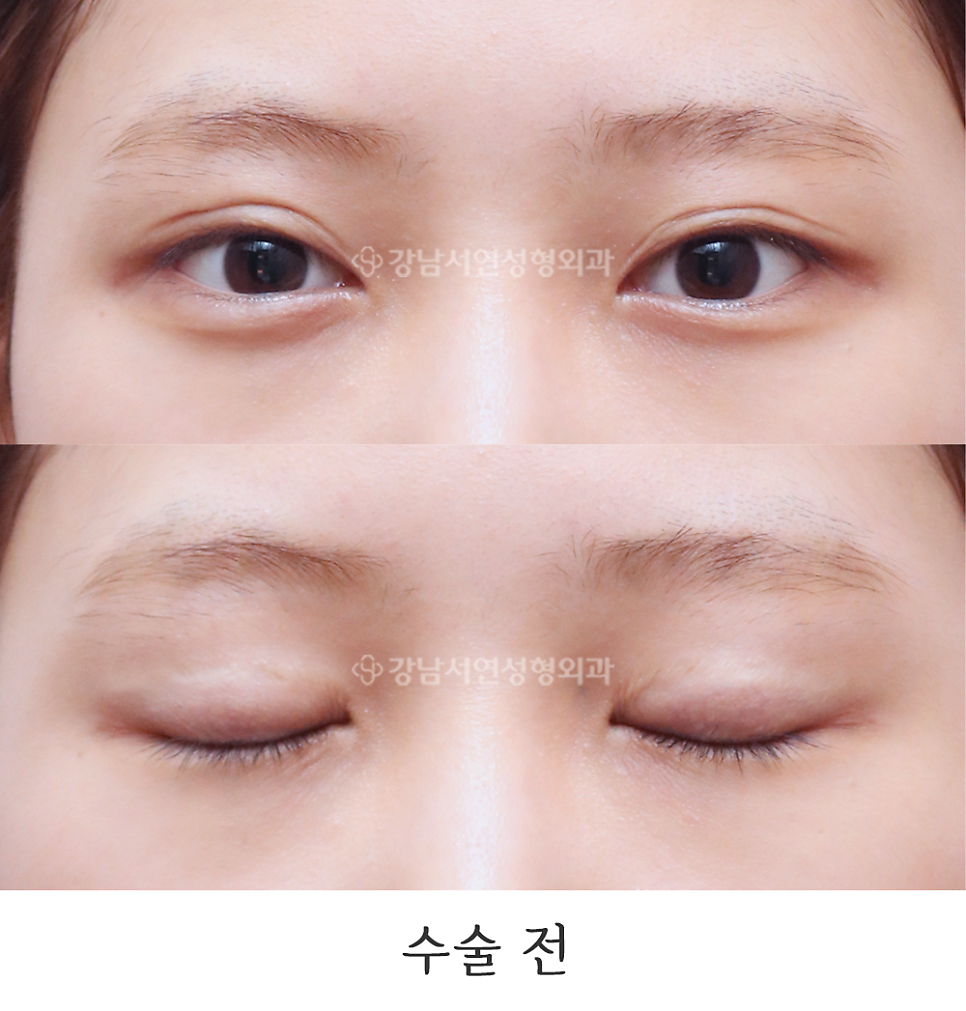 쌍꺼풀 재수술 전 사진