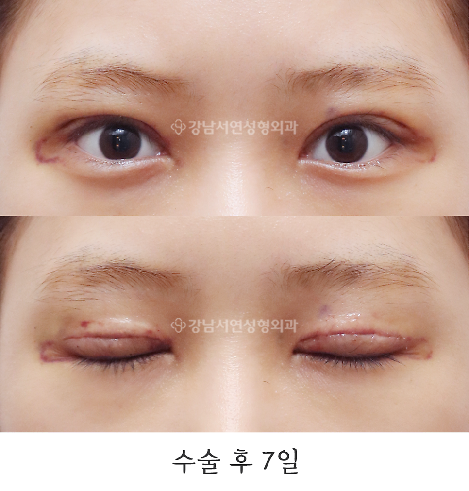 쌍꺼풀 재수술 후 사진
