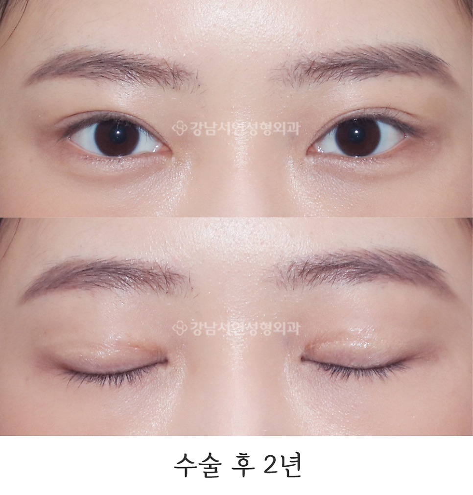 쌍꺼풀 재수술 후 사진