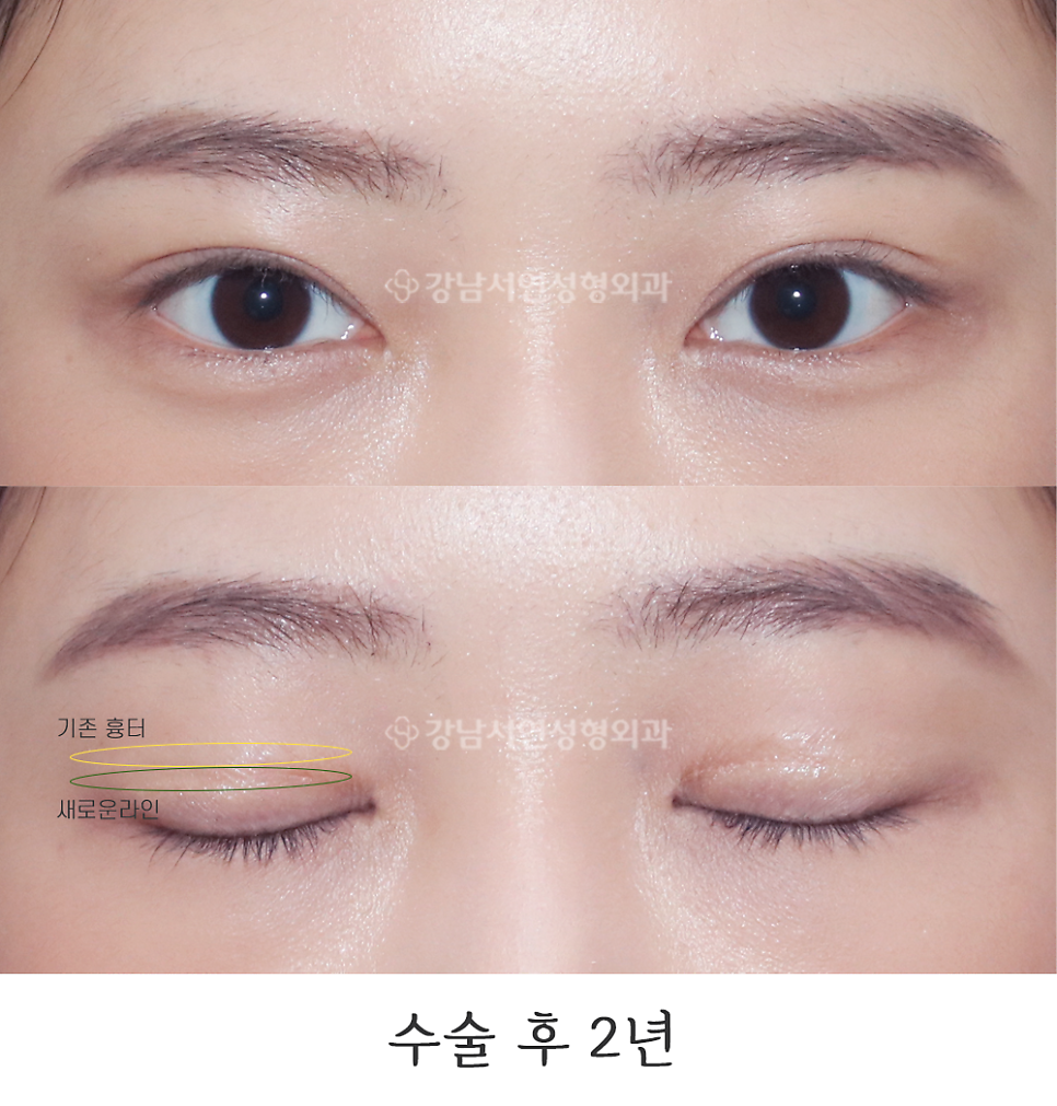 쌍꺼풀 재수술 후 사진