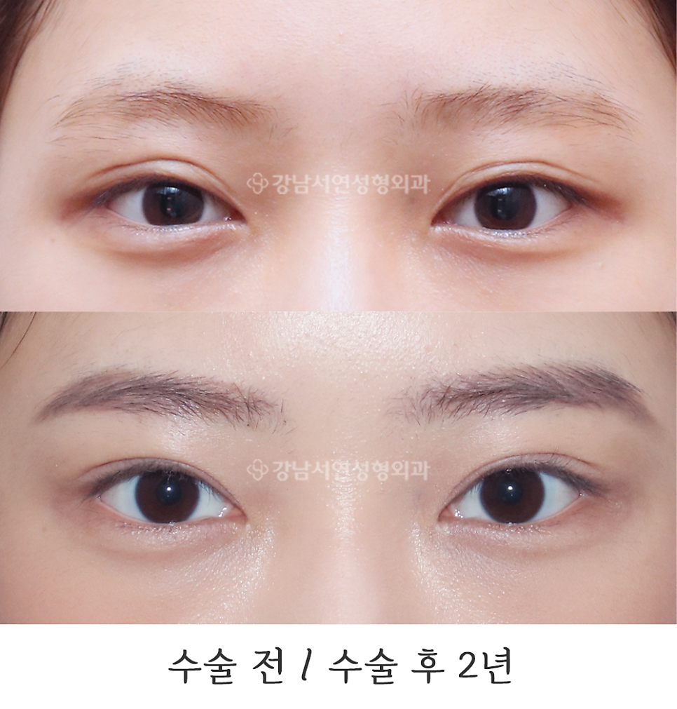쌍꺼풀 재수술 전후 비교 사진