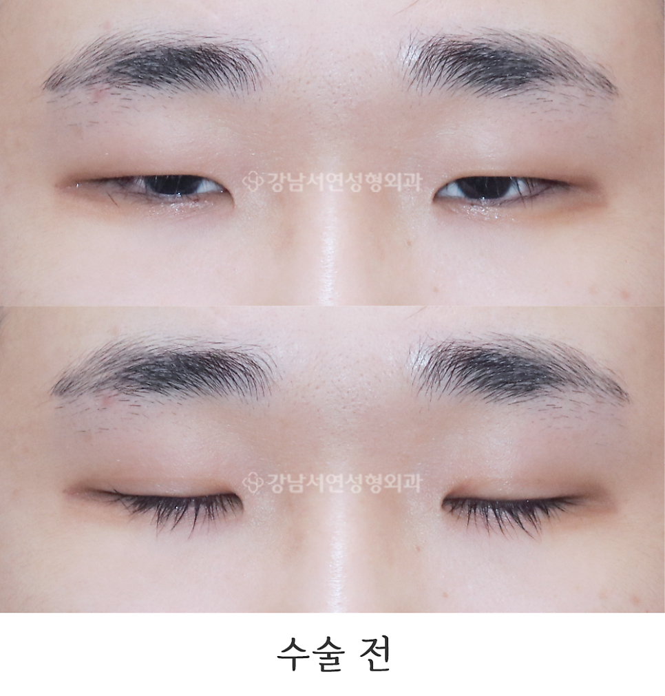 남자 눈성형 수술 전 사진
