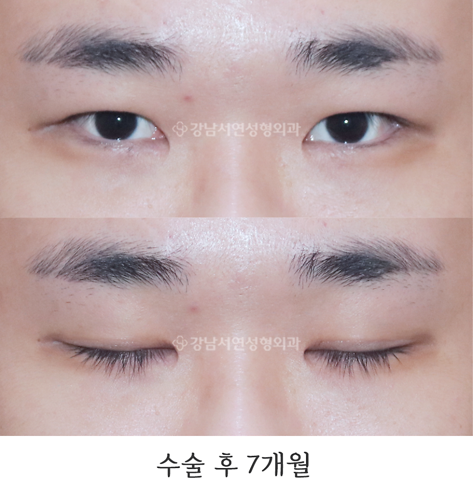 남자 눈성형 수술 후 사진