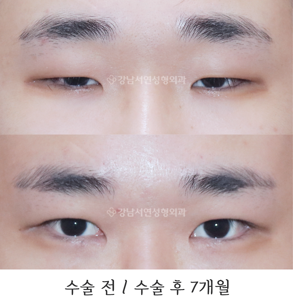 남자 눈성형 수술 전후 비교 사진