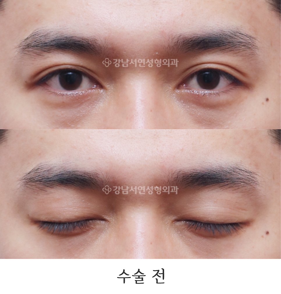남자 눈성형 수술 전 사진