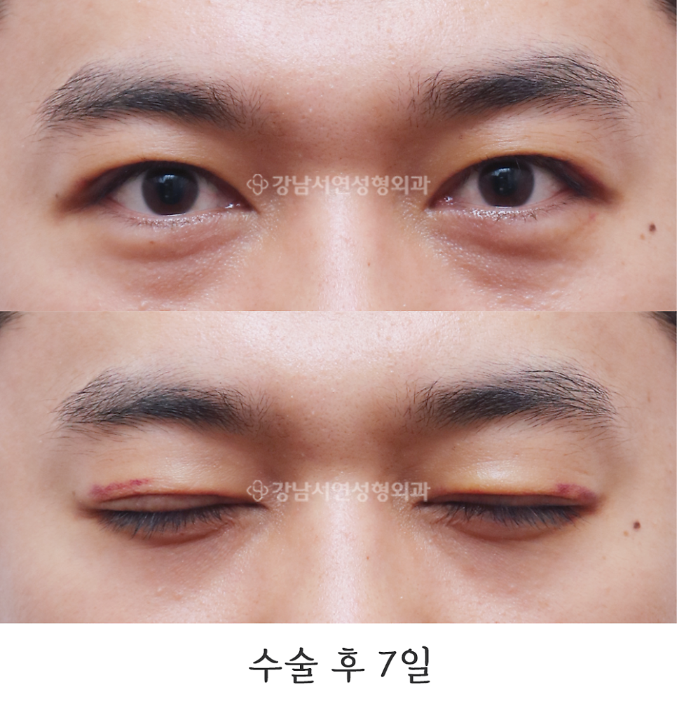 남자 눈성형 수술 후 사진