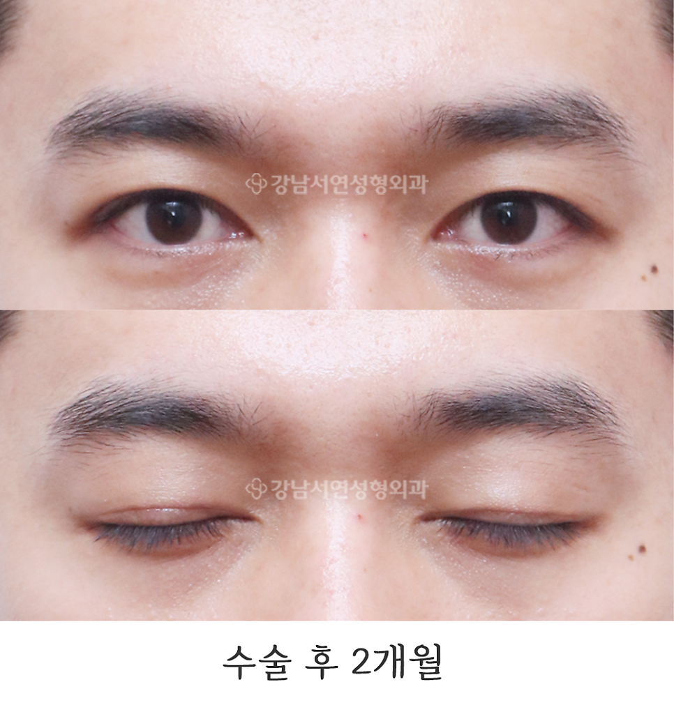 남자 눈성형 수술 후 사진