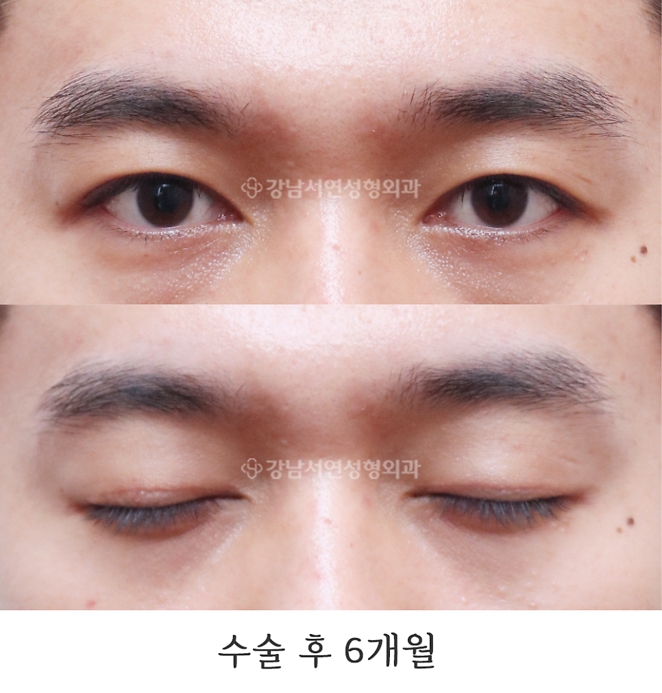 남자 눈성형 수술 후 사진