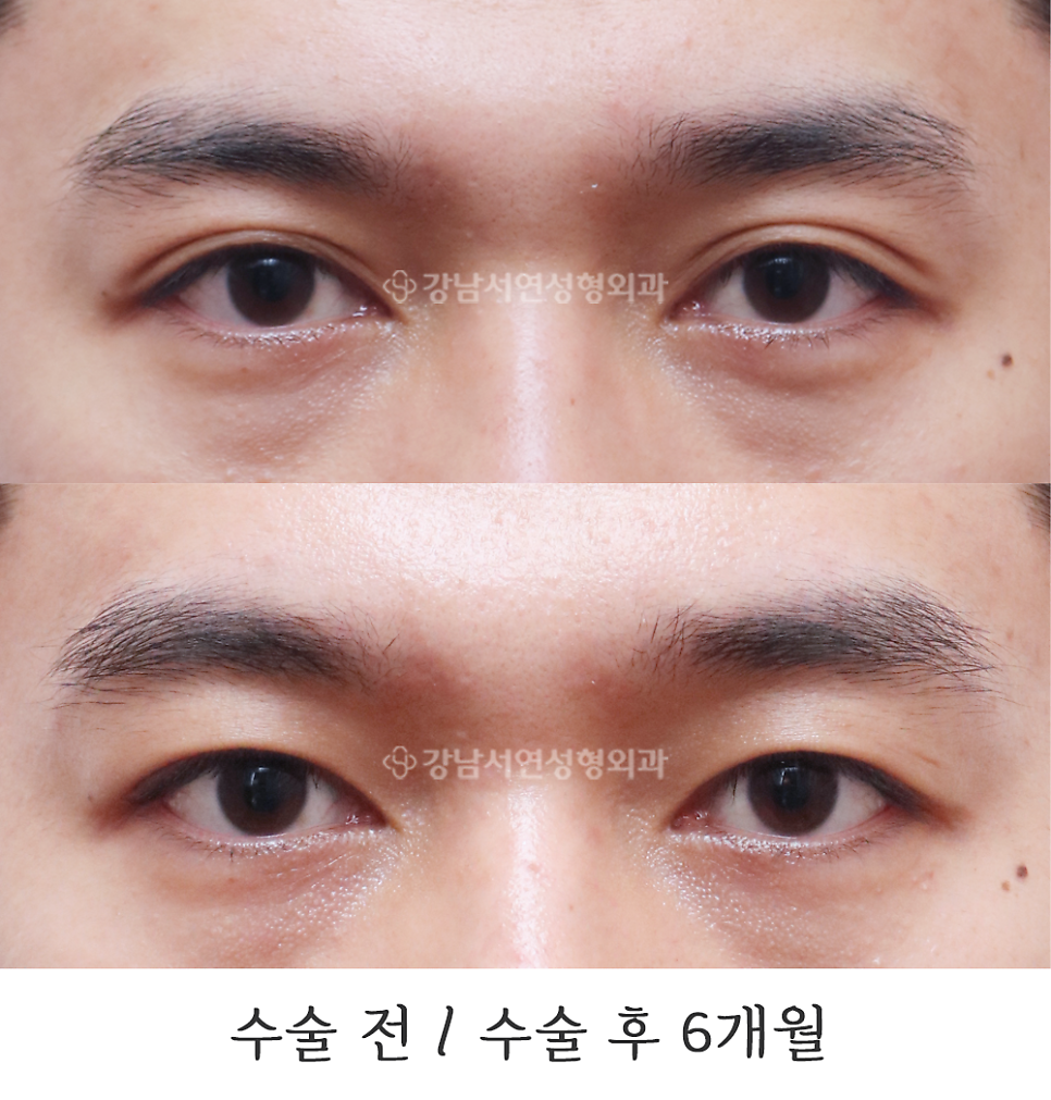 남자 눈성형 수술 전후 비교 사진