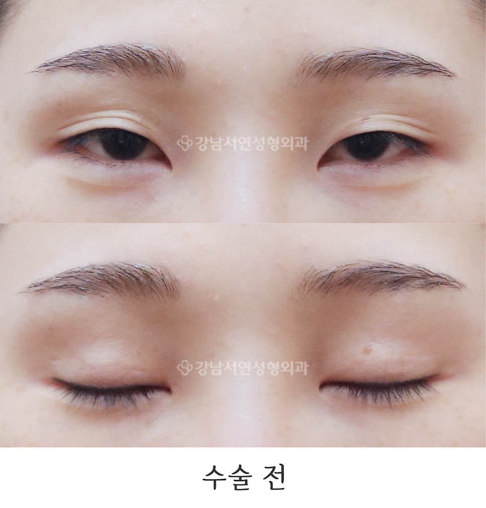 쌍꺼풀 재수술 전 사진