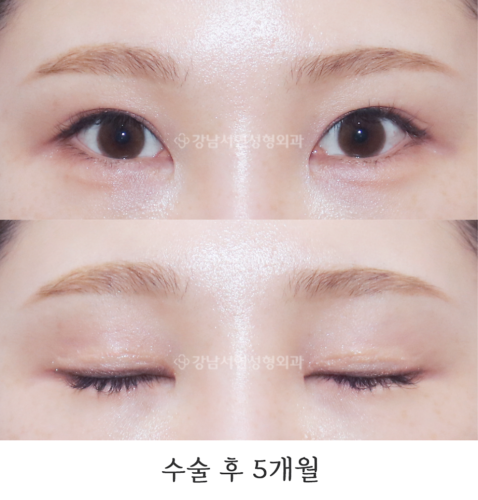 쌍꺼풀 재수술 후 사진