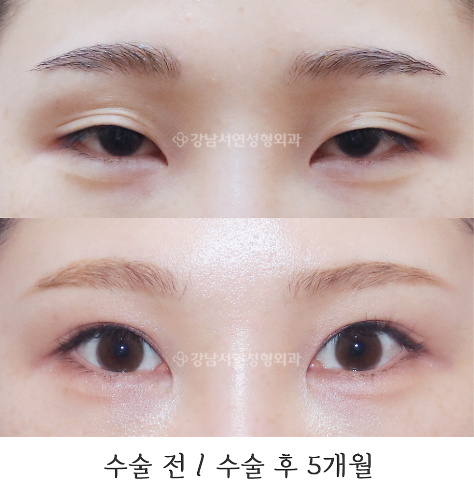 쌍꺼풀 재수술 전후 비교 사진