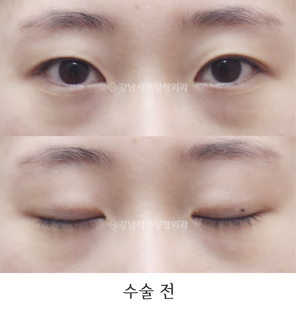 눈매 트임 수술 전 사진