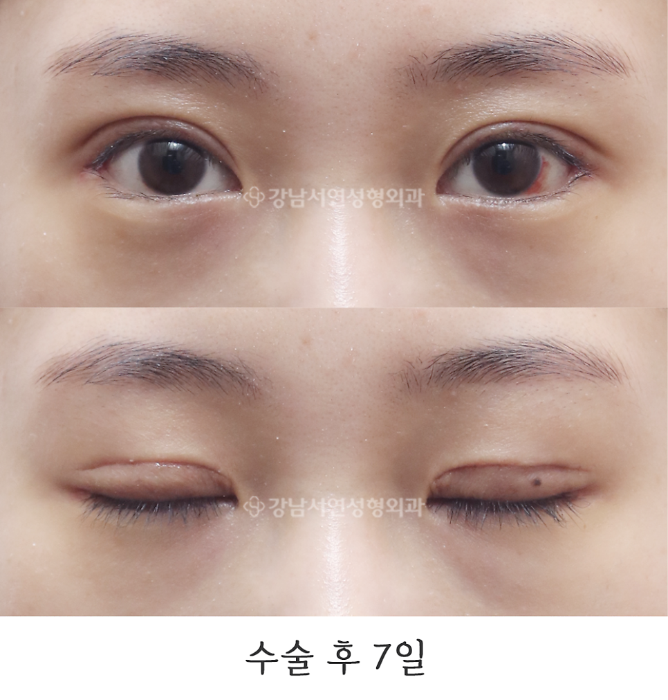 눈매 트임 수술 후 사진