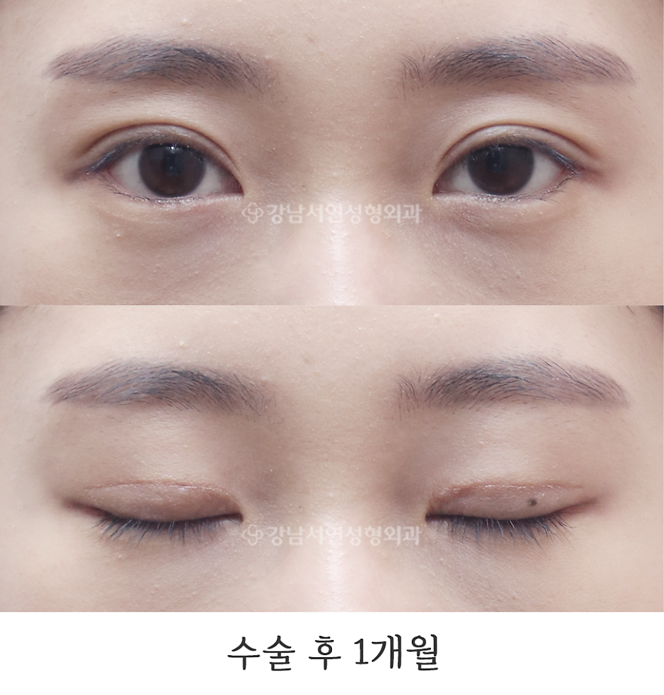 눈매 트임 수술 후 사진