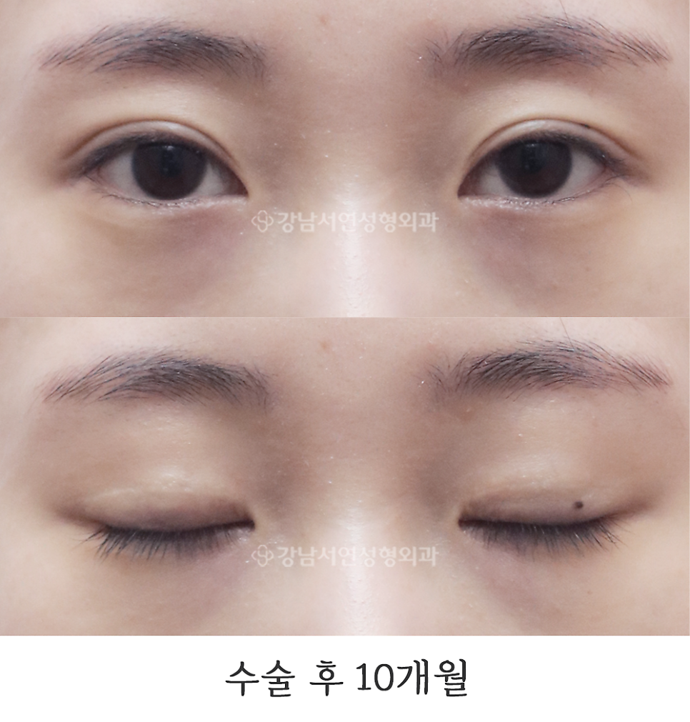 눈매 트임 수술 후 사진