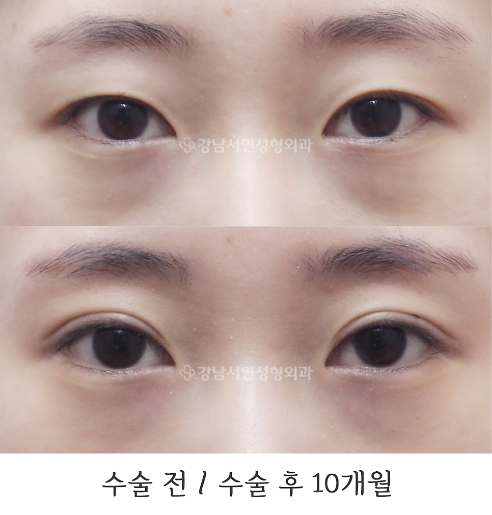 눈매 트임 수술 전후 비교 사진