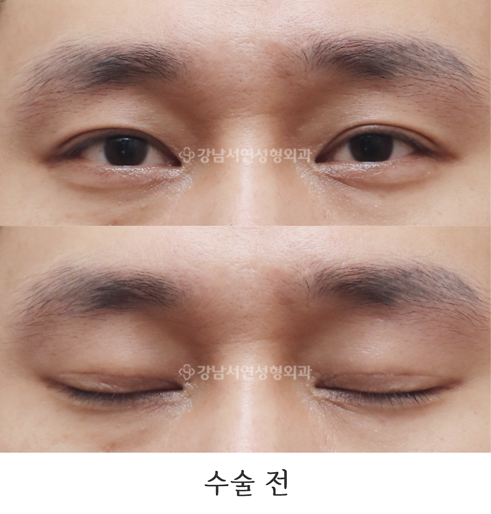 쌍꺼풀 재수술 전 사진