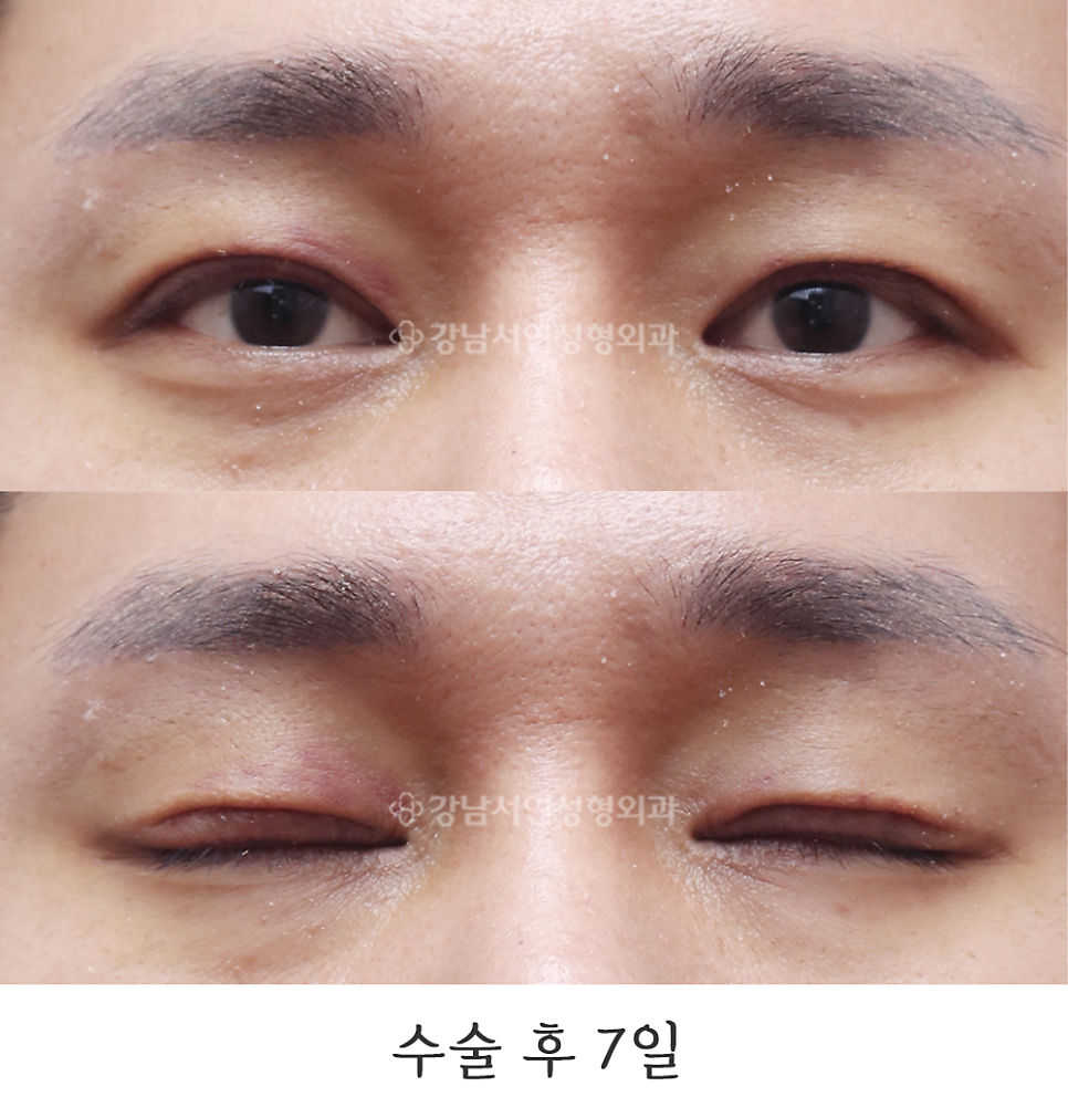 쌍꺼풀 재수술 후 사진