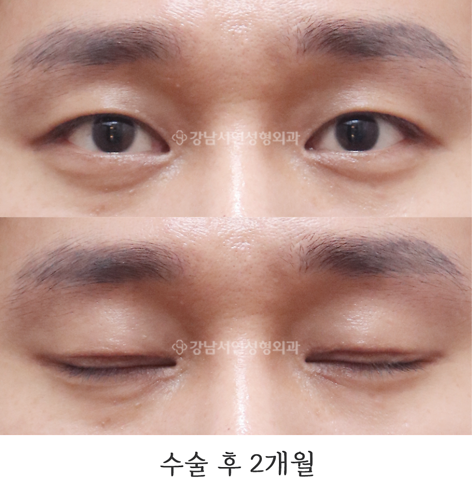 쌍꺼풀 재수술 후 사진