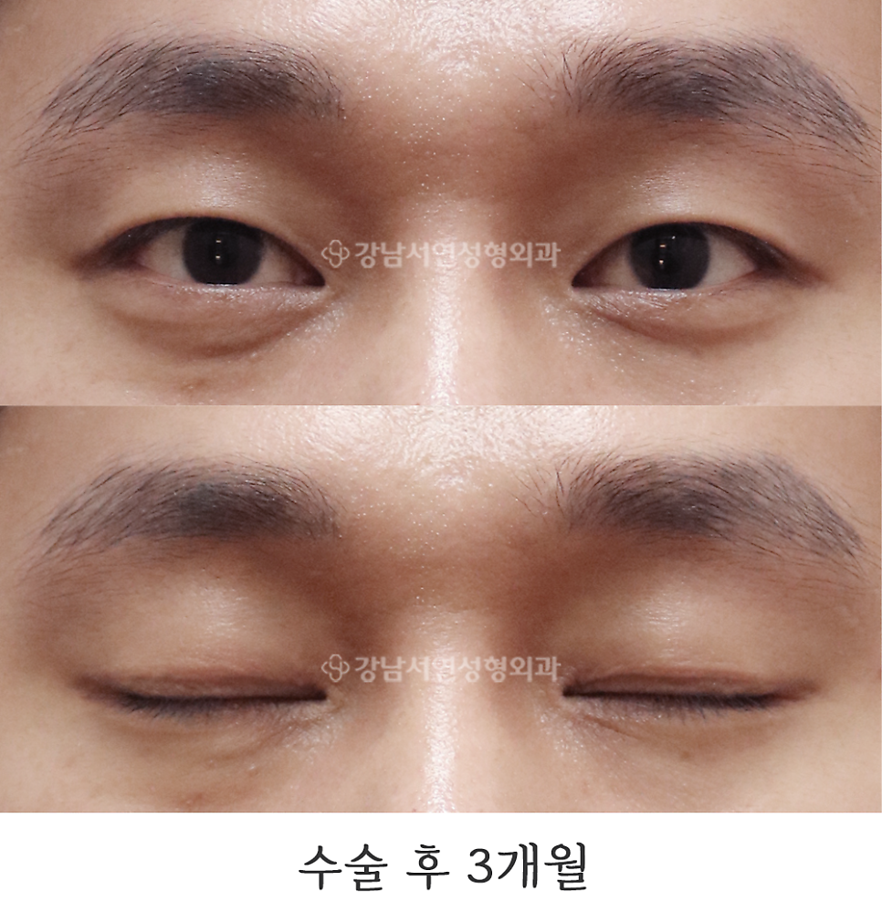 쌍꺼풀 재수술 후 사진