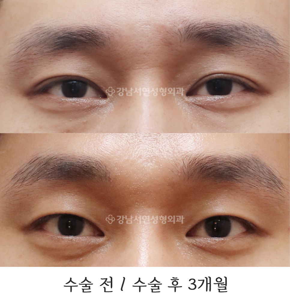 쌍꺼풀 재수술 전후 비교 사진