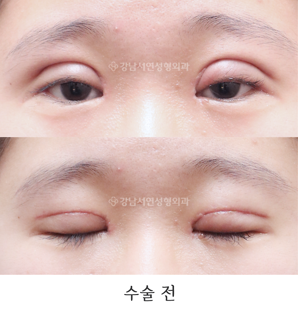 쌍꺼풀 재수술 전 사진