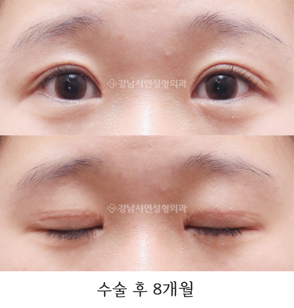 쌍꺼풀 재수술 후 사진