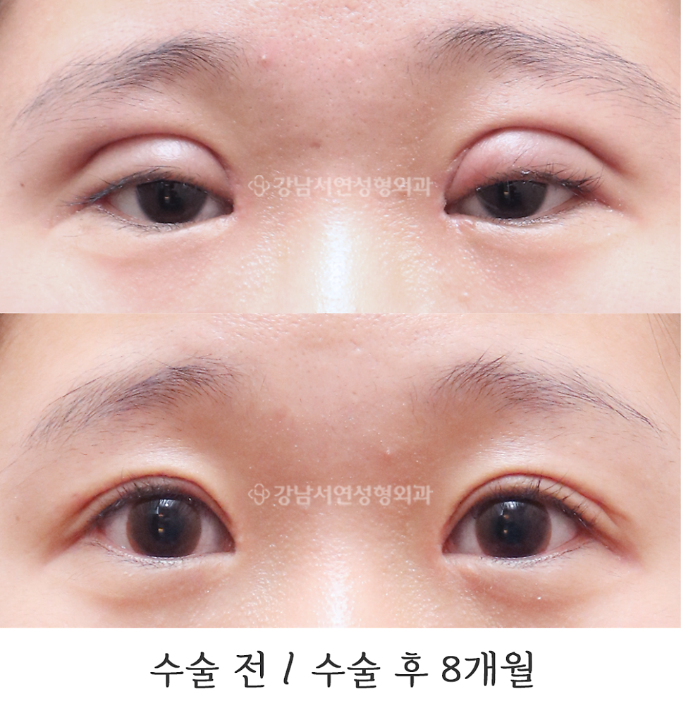 쌍꺼풀 재수술 전후 비교 사진
