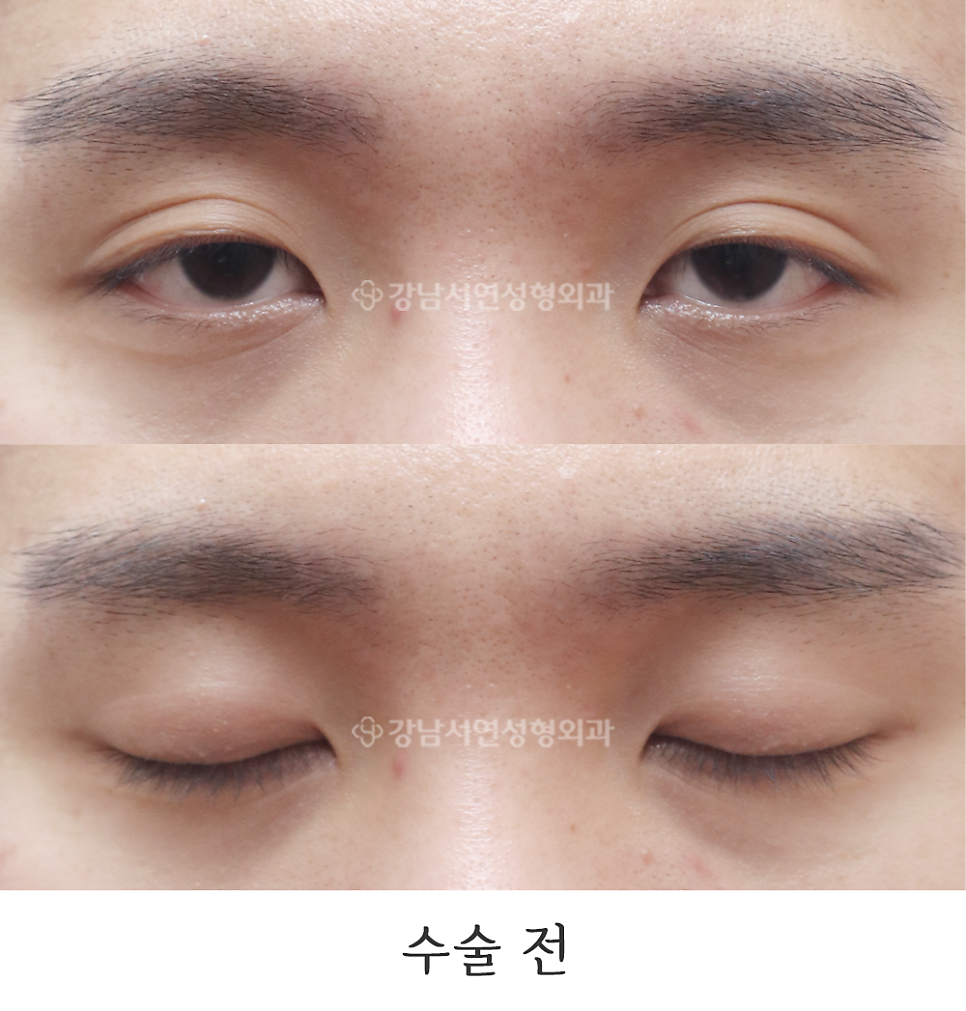 남자 눈성형 수술 전 사진