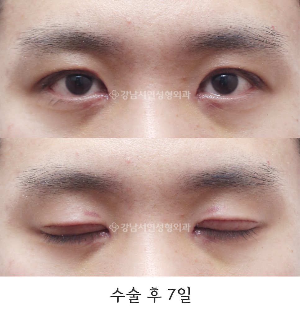 남자 눈성형 수술 후 사진