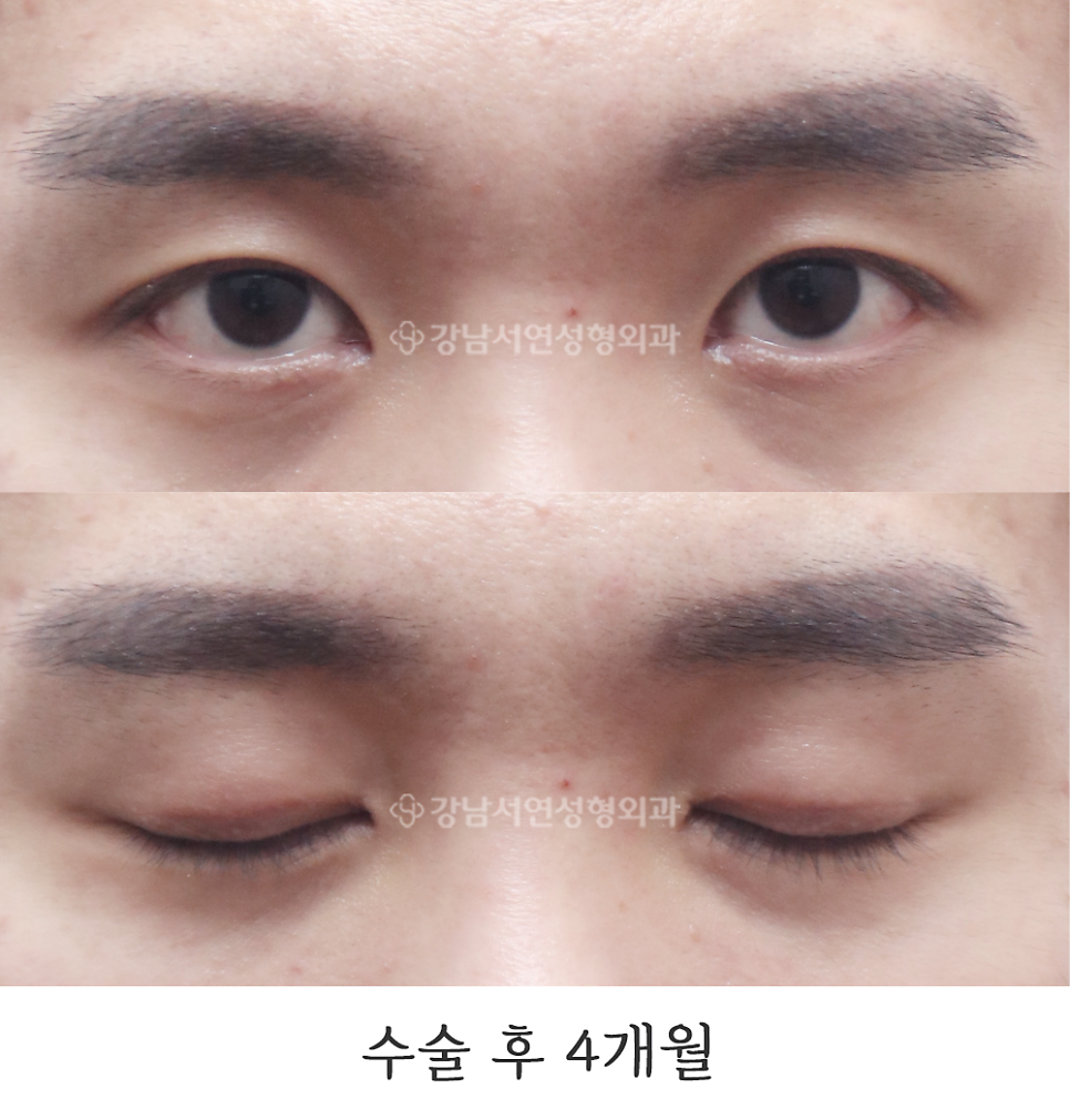남자 눈성형 수술 후 사진