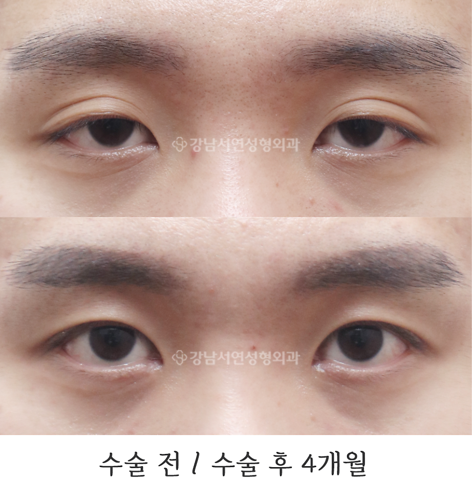 남자 눈성형 수술 전후 비교 사진