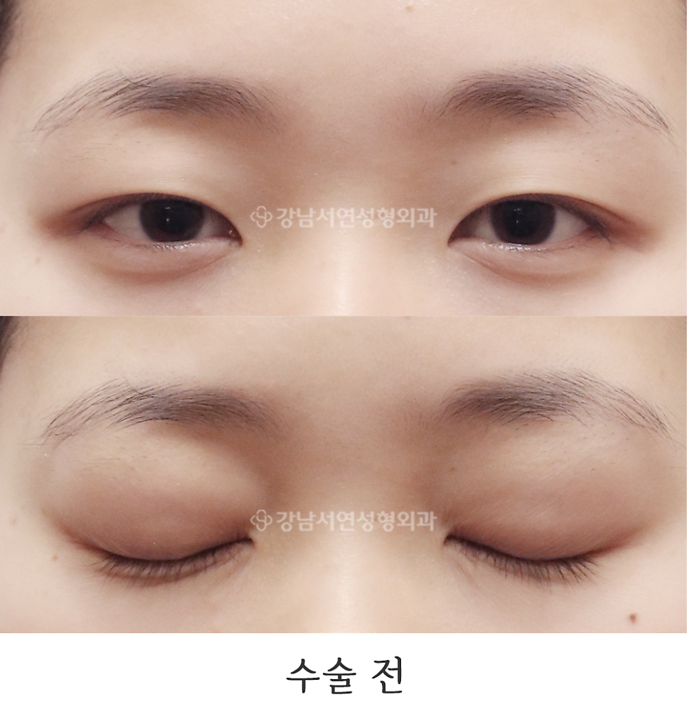 눈매 트임 수술 전 사진
