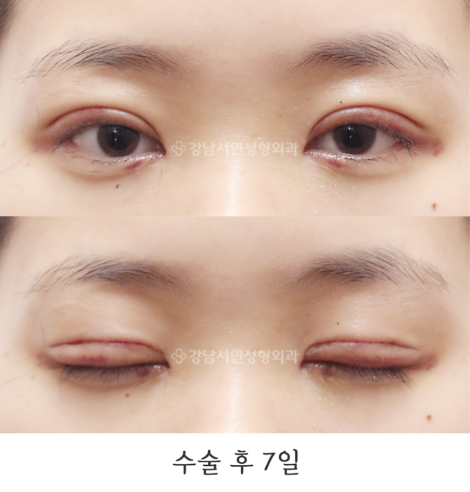 눈매 트임 수술 후 사진