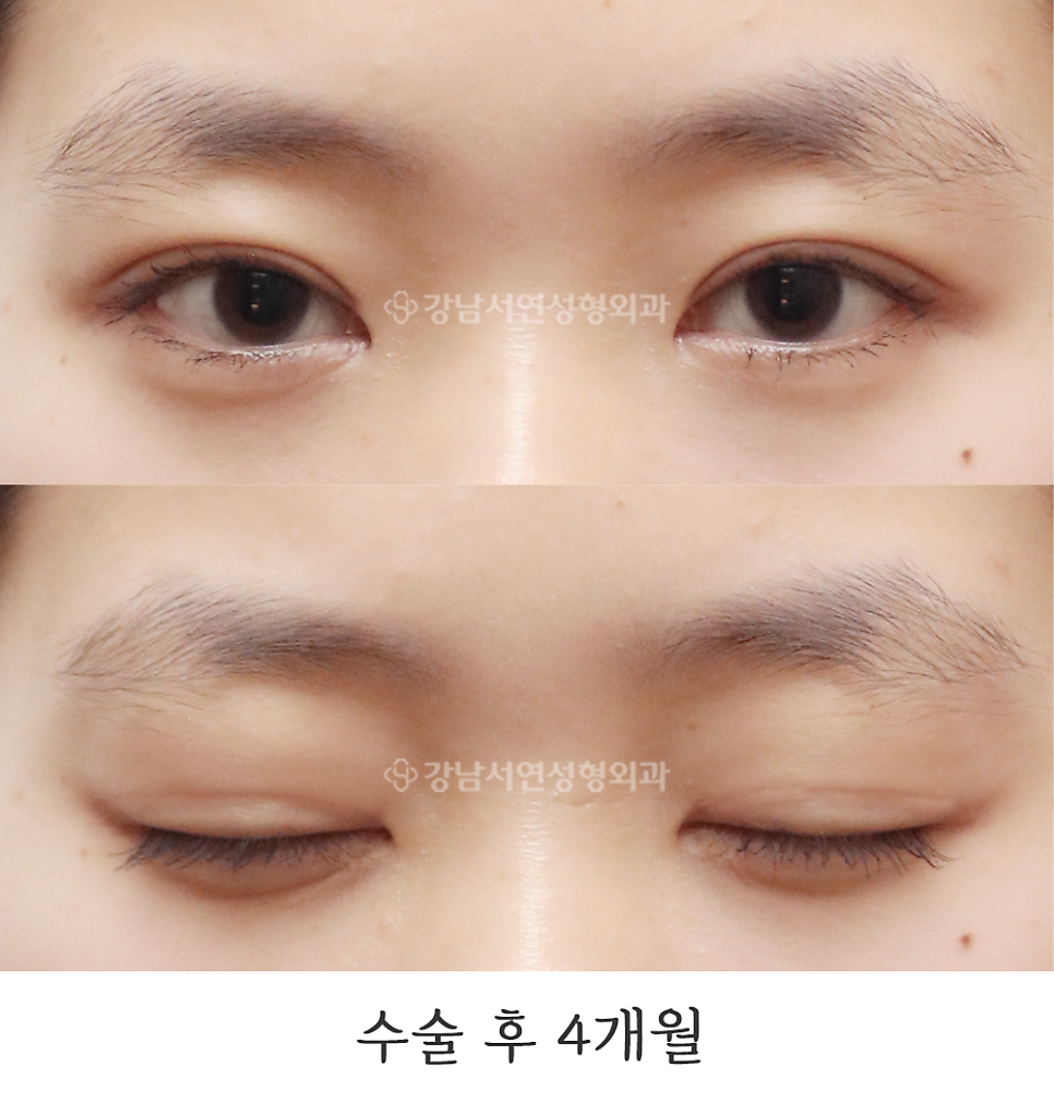 눈매 트임 수술 후 사진