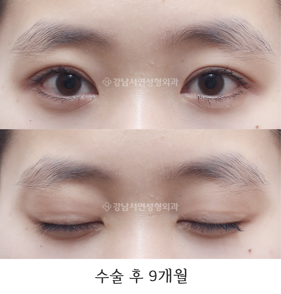 눈매 트임 수술 후 사진