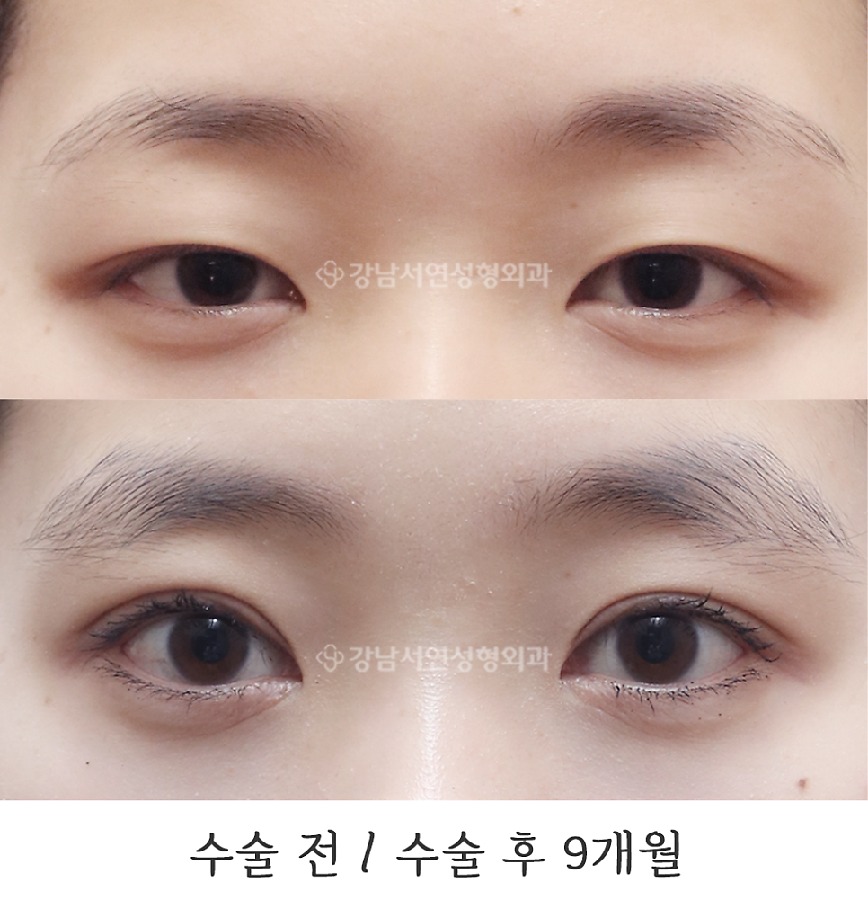 눈매 트임 수술 전후 비교 사진