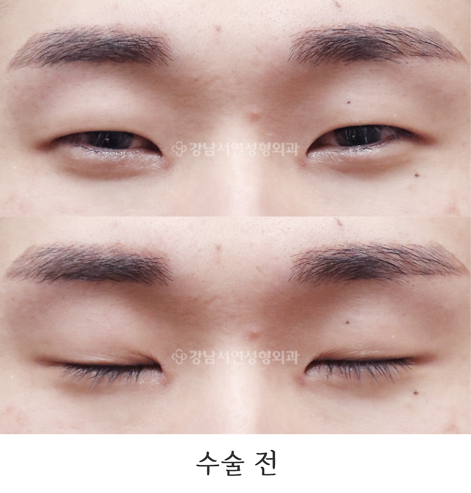 남자 눈성형 수술 전 사진
