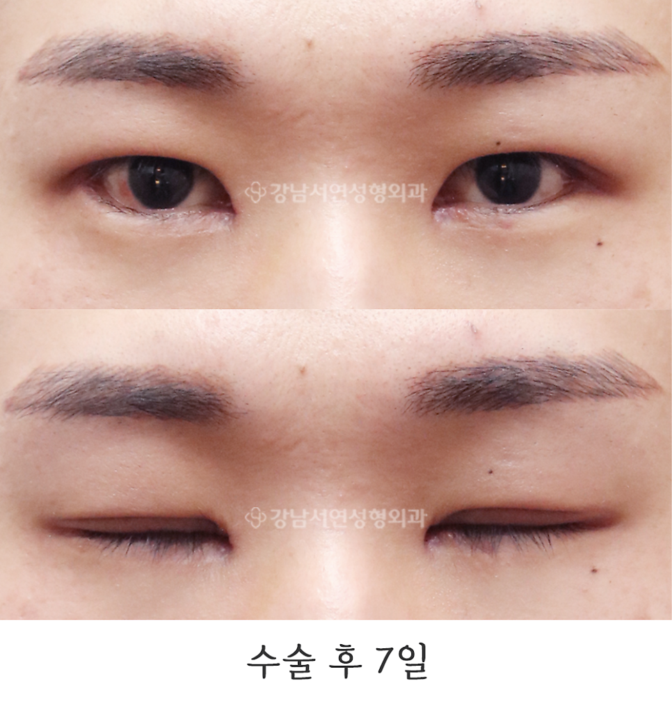 남자 눈성형 수술 후 사진