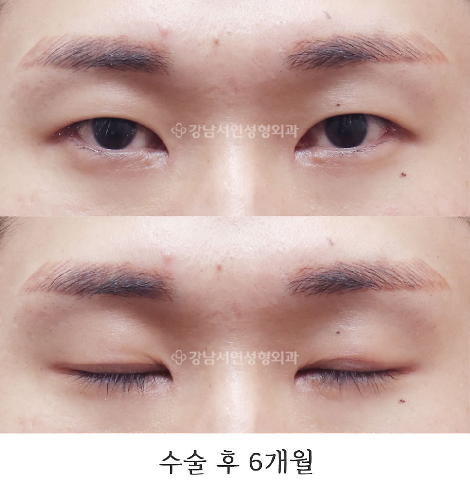 남자 눈성형 수술 후 사진