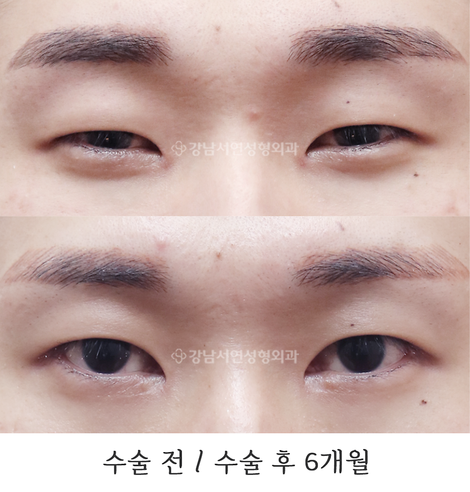 남자 눈성형 수술 전후 비교 사진