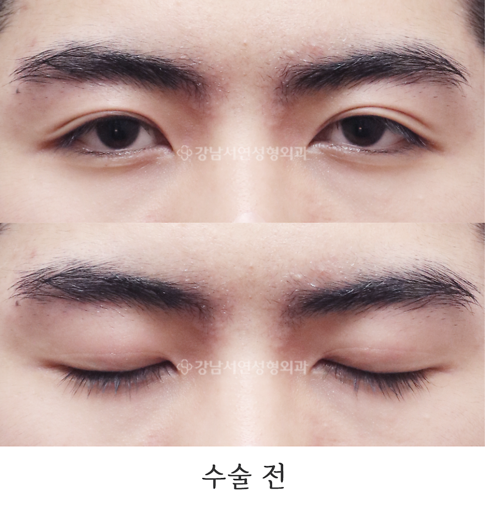 남자 눈성형 수술 전 사진