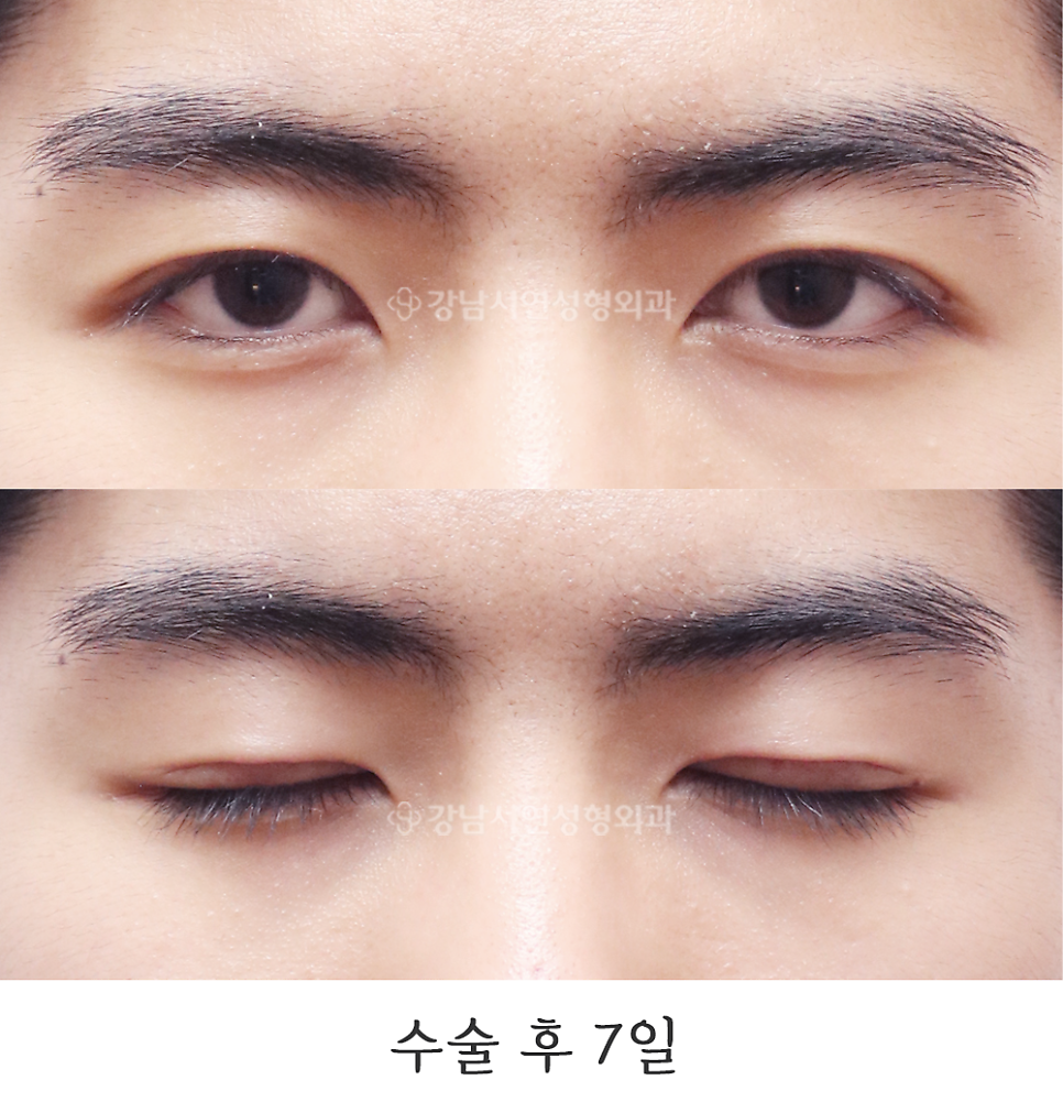 남자 눈성형 수술 후 사진